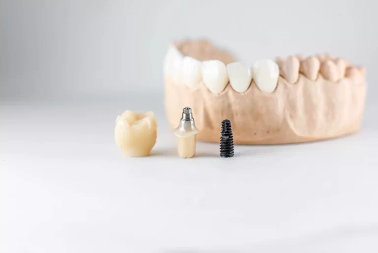 dental-implants