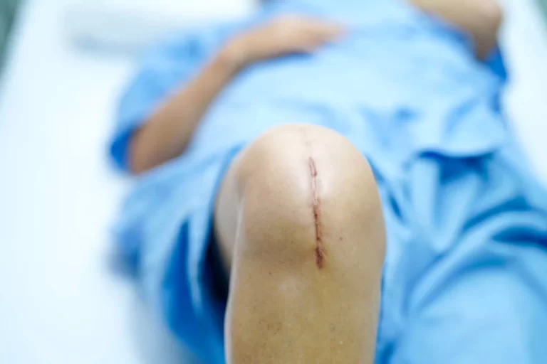 knee-arthroplasty