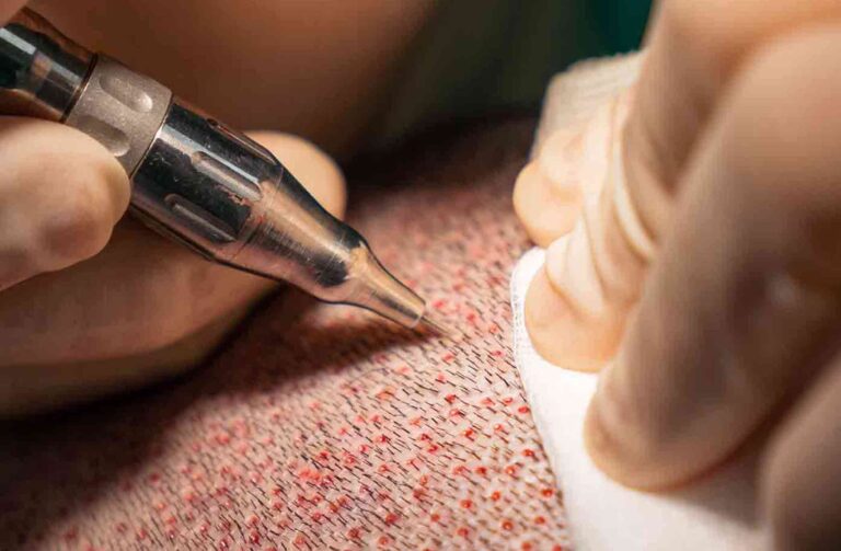 sapphire-&-fue-hair-transplant