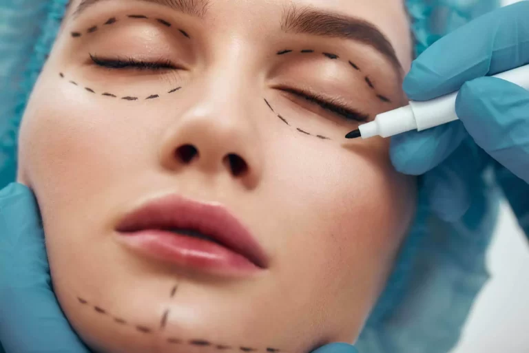 eyelid-surgery